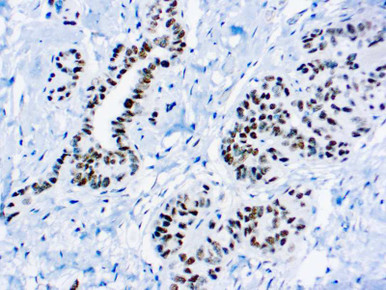 WT1 (Wilms Tumor 1 Protein), Clone 6F-H2
