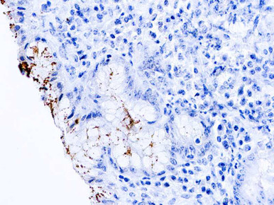 H. Pylori (P), (2X)