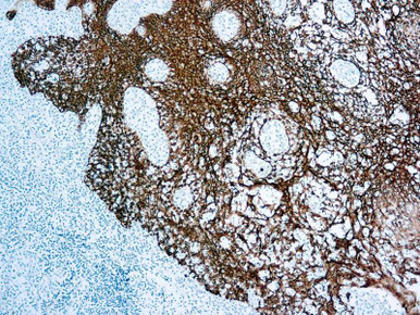 Cytokeratin (45, 46, 56.5), Clone MNF116