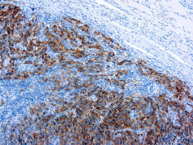 Melanoma, Clone HMB45 (Manual Use)
