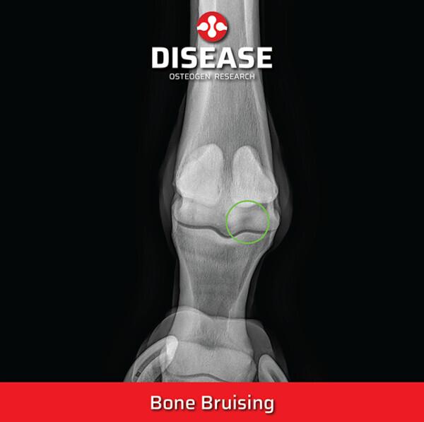 Bone Bruising