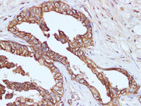 Immunohistochemistry of paraffin-embedded Human pancreatic cancer using CYCS Polyclonal Antibody at dilution of 1:100
