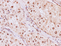 Immunohistochemistry of paraffin-embedded Human liver cancer using SF3B3 Polyclonal Antibody at dilution of 1:200