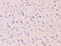 Immunohistochemistry of paraffin-embedded human gliomas using RAB5A Polyclonal Antibody at dilution of 1:200