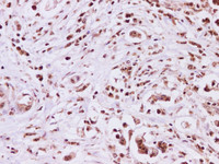 Immunohistochemistry of paraffin-embedded Human pancreas cancer tissue using ATXN3 Polyclonal Antibodyat dilution of 1:200
