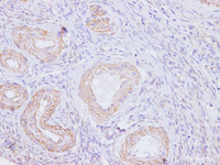 Immunohistochemistry of paraffinembedded Human ovarian using p16 Polyclonal Antibody at dilution of 1:100