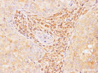 Immunohistochemistry of paraffin-embedded Human breast cancer using Il2 Polyclonal Antibody at dilution of 1:100