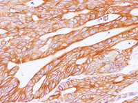 Immunohistochemistry of paraffin-embedded Human carcinoma of Colon using POSTN Polyclonal Antibody at dilution of 1:100 (400×)