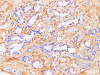 Immunohistochemistry of paraffin-embedded Human breast cancer using POSTN Polyclonal Antibody at dilution of 1:100