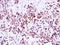 Immunohistochemistry of paraffin-embedded Human breast cancer using BRCA1 Polyclonal Antibody at dilution of 1:100
