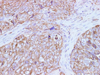 Immunohistochemistry of paraffin-embedded Human ovarian cancer using AFP Polyclonal Antibody at dilution of 1:50