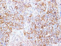 Immunohistochemistry of paraffin-embedded Human ovarian cancer using BBC3 Polyclonal Antibody at dilution of 1:100