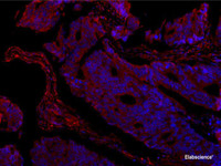 Immunofluorescence analysis of paraffin-embedded human colon cancer using COL1A1 Antibody at dilution of 1:150.