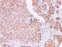 Immunohistochemistry of paraffin-embedded Human liver cancer using AFP Polyclonl Antibody at dilution of 1:200 (100×) .