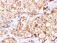 Immunohistochemistry of paraffin-embedded Human liver cancer using AFP Polyclonl Antibody at dilution of 1:200 (400×) .