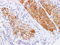 Immunohistochemistry of paraffin-embedded Human stomach cancer using FUT3 Polyclonl Antibody at dilution of 1:200.