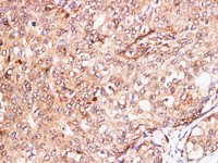 Immunohistochemistry of paraffin-embedded Human breast cancer using S100A11 Polyclonal Antibody at dilution of 1:200