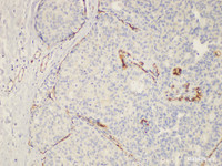 Immunohistochemistry of paraffin-embedded Human breast cancer using ENG Ployclonal Antibody at dilution of 1:200.