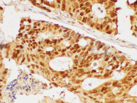 Immunohistochemistry of paraffin-embedded Human colon cancer using PCNA Polycloanl Antibody at dilution of 1:50
