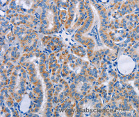 Immunohistochemistry of paraffin-embedded Human thyroid cancer tissue using FN1 Polyclonal Antibody at dilution 1:50