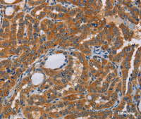 Immunohistochemistry of paraffin-embedded Human thyroid cancer tissue using CK-13 Polyclonal Antibody at dilution 1:50