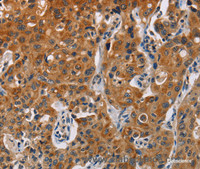 Immunohistochemistry of paraffin-embedded Human lung cancer tissue using CK-13 Polyclonal Antibody at dilution 1:50