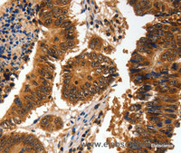 Immunohistochemistry of paraffin-embedded Human colon cancer using ADAP1 Polyclonal Antibody at dilution of 1:60