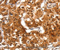 Immunohistochemistry of paraffin-embedded Human lung cancer using ADAP1 Polyclonal Antibody at dilution of 1:60