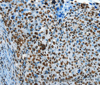 Immunohistochemistry of paraffin-embedded Human cervical cancer tissue using CREB1 Polyclonal Antibody at dilution 1:30