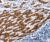 Immunohistochemistry of paraffin-embedded Human liver cancer using AIFM1 Polyclonal Antibody at dilution of 1:30