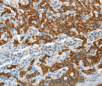 Immunohistochemistry of paraffin-embedded Human gastric cancer tissue using CK-18 Polyclonal Antibody at dilution 1:50