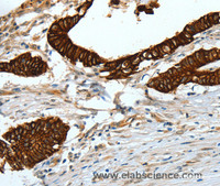 Immunohistochemistry of paraffin-embedded Human colon cancer tissue using CK-18 Polyclonal Antibody at dilution 1:50
