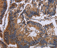 Immunohistochemistry of paraffin-embedded Human colon cancer using KRT31 Polyclonal Antibody at dilution of 1:30
