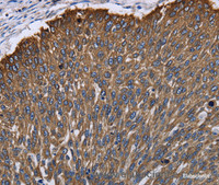 Immunohistochemistry of paraffin-embedded Human lung cancer using KRT31 Polyclonal Antibody at dilution of 1:30