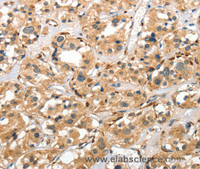 Immunohistochemistry of paraffin-embedded Human thyroid cancer using Cathepsin E Polyclonal Antibody at dilution of 1:40