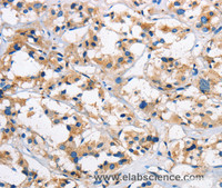 Immunohistochemistry of paraffin-embedded Human thyroid cancer tissue using Cathepsin L Polyclonal Antibody at dilution 1:50
