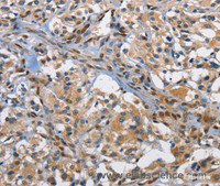 Immunohistochemistry of paraffin-embedded Human thyroid cancer using c-Fos Polyclonal Antibody at dilution of 1:70
