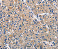 Immunohistochemistry of paraffin-embedded Human liver cancer tissue using CLEC2D Polyclonal Antibody at dilution 1:70