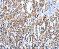 Immunohistochemistry of paraffin-embedded Human esophagus cancer tissue using EDN3 Polyclonal Antibody at dilution 1:30