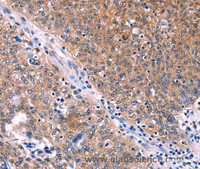 Immunohistochemistry of paraffin-embedded Human ovarian cancer tissue using EDN1 Polyclonal Antibody at dilution 1:50