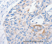 Immunohistochemistry of paraffin-embedded Human esophagus cancer tissue using FANCF Polyclonal Antibody at dilution 1:100