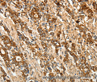 Immunohistochemistry of paraffin-embedded Human gastic cancer using CALR Polyclonal Antibody at dilution of 1:50