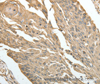 Immunohistochemistry of paraffin-embedded Human cervical cancer using HSP90B1 Polyclonal Antibody at dilution of 1:30