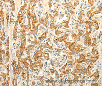 Immunohistochemistry of paraffin-embedded Human gasrtic cancer tissue using ERG Polyclonal Antibody at dilution 1:30