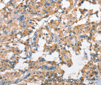 Immunohistochemistry of paraffin-embedded Human thyroid cancer tissue using SCARB1 Polyclonal Antibody at dilution 1:60
