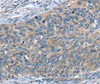 Immunohistochemistry of paraffin-embedded Human cervical cancer tissue using SCARB1 Polyclonal Antibody at dilution 1:60