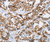 Immunohistochemistry of paraffin-embedded Human thyroid cancer tissue using HINT2 Polyclonal Antibody at dilution 1:40