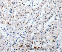 Immunohistochemistry of paraffin-embedded Human lung cancer tissue using HSPA1A Polyclonal Antibody at dilution 1:60