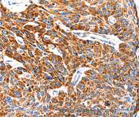 Immunohistochemistry of paraffin-embedded Human esophagus cancer using HSP75 Polyclonal Antibody at dilution of 1:100