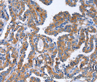 Immunohistochemistry of paraffin-embedded Human thyroid cancer tissue using IGSF10 Polyclonal Antibody at dilution 1:50